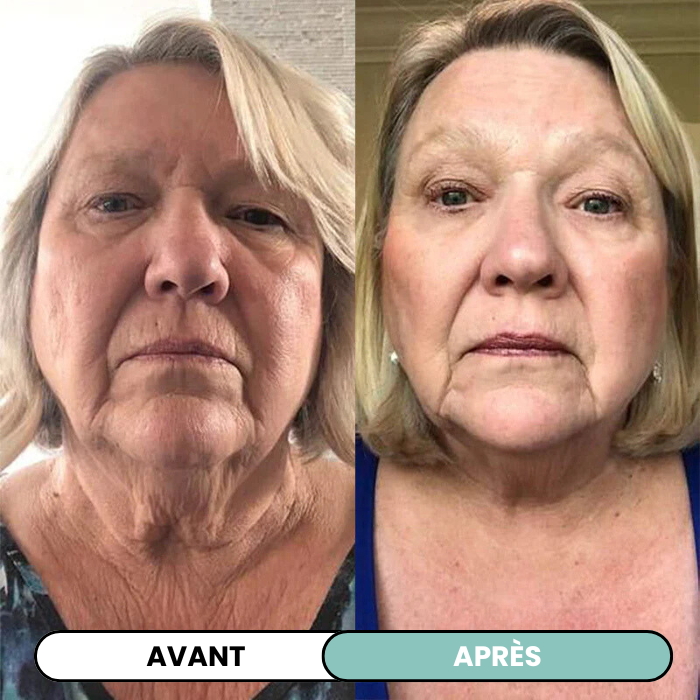 Kit Micro infusion anti-âge